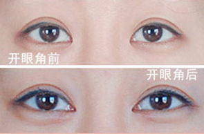 要更大更有神的眼睛，开眼角手术前后对比图